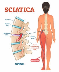 سیاتیک چیست